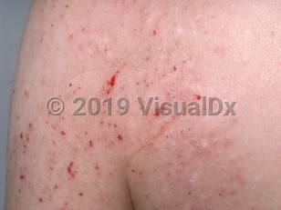 Clinical image of Pediculosis corporis