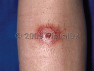 Clinical image of Spider bite - imageId=76956. Click to open in gallery.  caption: 'An eroded, erythematous nodule on the shin.'