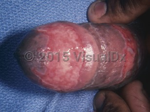 Clinical image of Erosive balanitis - imageId=7703531. Click to open in gallery.  caption: 'Large, well-demarcated erosions on the penis.'