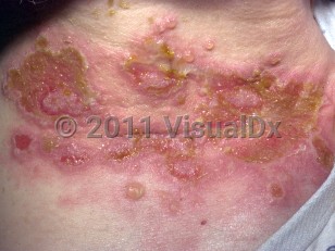 Clinical image of Paraneoplastic pemphigus - imageId=770851. Click to open in gallery.  caption: 'A close-up of large, crusted erosions with some purulence in areas, and surrounding erythema and flaccid vesicles on the lateral neck.'