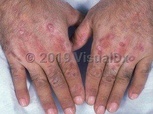 Clinical image of Porphyria cutanea tarda - imageId=775172. Click to open in gallery.  caption: 'Crusted erosions and erythema on the dorsal hands and fingers.'