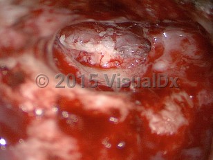 Clinical image of Cholesteatoma - imageId=7756231. Click to open in gallery. 