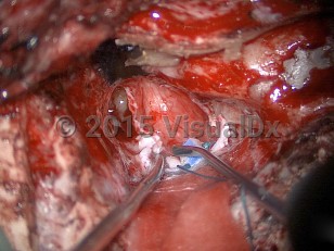 Clinical image of Vestibular schwannoma