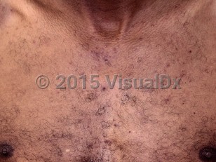 Clinical image of EGFR inhibitor-induced acneiform eruption - imageId=7757239. Click to open in gallery.  caption: 'Scattered acneiform papules and tiny pustules on the chest.<br/><br/>Image appears with permission from East Carolina University Division of Dermatology.'