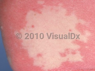 Clinical image of Pityriasis rubra pilaris - imageId=776192. Click to open in gallery.  caption: 'A close-up of an area of normal skin ("island of sparing") surrounded by a deep pink, scaly plaque.'