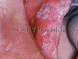Clinical image of Leukoplakia - imageId=779107. Click to open in gallery.  caption: 'A sizeable white plaque on the buccal mucosa.'
