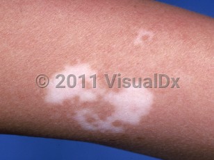 Clinical image of Vitiligo - imageId=779676. Click to open in gallery.  caption: 'A white macule and a similar patch on the forearm.'