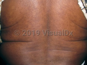 Clinical image of Progressive macular hypomelanosis - imageId=7809983. Click to open in gallery.  caption: 'Widespread patchy hypopigmentation on the back.'