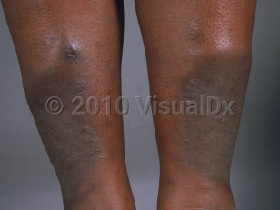 Clinical image of Pretibial myxedema - imageId=781247. Click to open in gallery.  caption: 'Bound-down dark brown plaques and similar nodules on the lower shins.'