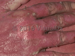 Clinical image of Erythrodermic psoriasis