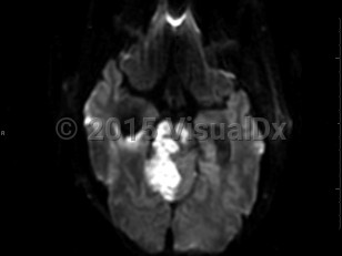Imaging Studies image of Brain stem stroke - imageId=7872077. Click to open in gallery.  caption: 'Axial MR image demonstrates increased signal on DWI and corresponding low ADC values in the right cerebellum and brain stem, consistent with stroke.<br /><br />'
