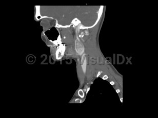 Imaging Studies image of Carotid body tumor