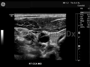 Imaging Studies image of Carotid artery dissection
