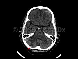 Imaging Studies image of Cerebellar contusion