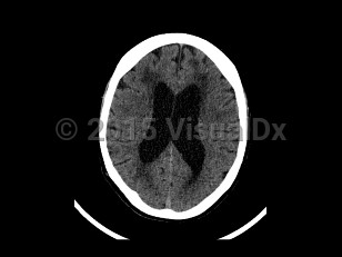 Imaging Studies image of Normal pressure hydrocephalus - imageId=7872880. Click to open in gallery.  caption: '<span>Axial CT image demonstrates  bilateral ventriculomegaly out of proportion to the degree of sulcal  enlargement. In this patient who presented with falls and urinary  incontinence, the imaging findings supported the clinical diagnosis of  normal pressure hydrocephalus.</span>'