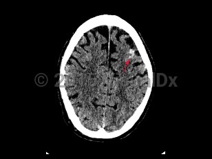 Imaging Studies image of Subarachnoid hemorrhage