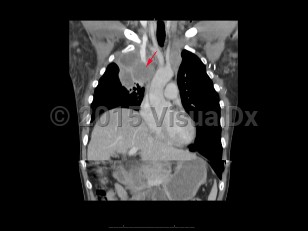 Imaging Studies image of Superior vena cava syndrome