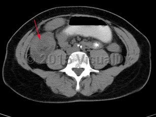 Imaging Studies image of Intussusception