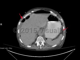 Imaging Studies image of Bowel perforation