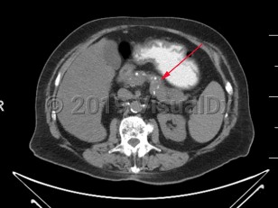 Imaging Studies image of Chronic pancreatitis - imageId=7877567. Click to open in gallery.  caption: '<span>Axial CT image demonstrates numerous coarse calcifications within the pancreas, consistent with chronic pancreatitis.</span>'