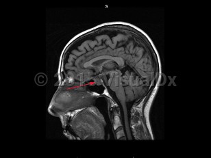 Imaging Studies image of Craniopharyngioma
