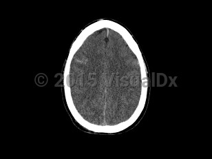 Imaging Studies image of Cerebral edema - imageId=7877814. Click to open in gallery.  caption: '<span>Axial CT image demonstrates  diffuse loss of the gray-white matter interface and sulcal prominence.  Findings were consistent with post-traumatic diffuse cerebral edema.</span>'
