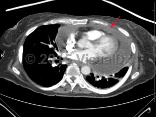 Imaging Studies image of Cardiac tamponade