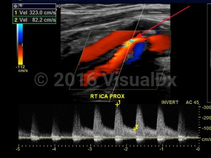 Imaging Studies image of Carotid artery stenosis - imageId=7878398. Click to open in gallery.  caption: '<span>Color and spectral Doppler image of the proxima right internal carotid artery demonstrating >70% stenosis.</span>'