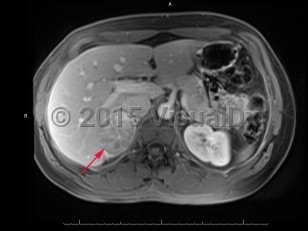 Imaging Studies image of Adrenocortical carcinoma - imageId=7878499. Click to open in gallery.  caption: '<span>Post-contrast MRI of the abdomen demonstrates heterogeneously enhancing right adrenal mass.</span>'