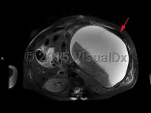 Imaging Studies image of Splenic infarction