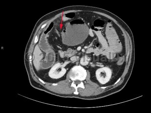 Imaging Studies image of Small bowel obstruction