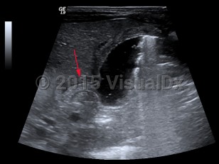 Imaging Studies image of Hypertrophic pyloric stenosis - imageId=7879501. Click to open in gallery.  caption: '<span>Hypertrophic pyloric stenosis  is seen on ultrasound image as  thickening of the pyloric muscle and  elongated pyloric canal length.</span>'