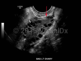 Imaging Studies image of Polycystic ovarian syndrome