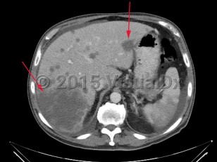 Imaging Studies image of Liver cancer