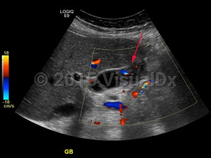 Imaging Studies image of Gallbladder carcinoma - imageId=7884800. Click to open in gallery.  caption: 'Ultrasound with color Doppler demonstrating mass within the gallbladder with internal vascularity.'