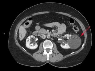 Imaging Studies image of Renal cysts - imageId=7885061. Click to open in gallery.  caption: '<span>Enhanced CT scan demonstrating left renal cyst.</span>'