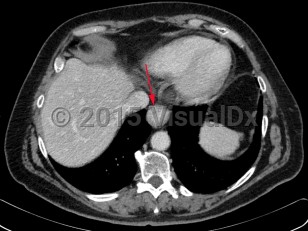 Imaging Studies image of Esophageal carcinoma
