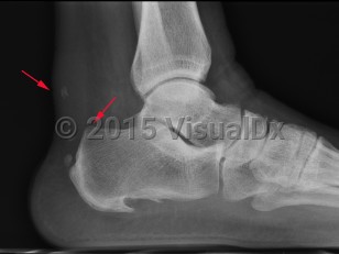 Imaging Studies image of Achilles tendonitis