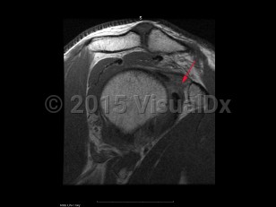 Imaging Studies image of Adhesive capsulitis of the shoulder