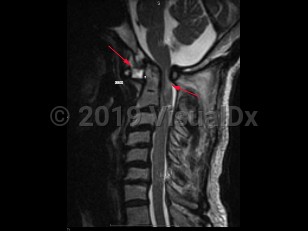 Imaging Studies image of Atlantoaxial instability - imageId=7887372. Click to open in gallery.  caption: '<span>Sag T2 MRI sequence  demonstrates atlantoaxial instablity/dislocation in a patient with  Down syndrome. Note that the atlantoaxial interval is widened  measuring up to 9-10mm and that there is compressive myelopathy of the  spinal cord secondary to narrowing of the spinal canal.</span>'