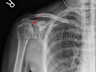 Imaging Studies image of Avascular necrosis of shoulder