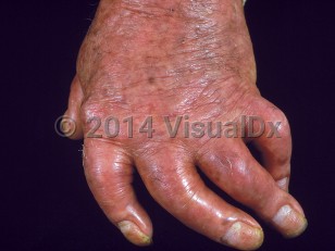 Clinical image of Psoriatic arthropathy - imageId=789580. Click to open in gallery.  caption: '<span>Arthritis mutilans.</span>'