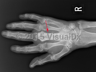 Imaging Studies image of Paget disease of bone - imageId=7896540. Click to open in gallery.  caption: '<span>Cortical and trabecular  thickening and sclerosis with an expanded appearance of the middle  finger metacarpal compatible with Paget disease.</span>'