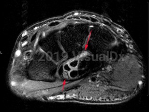 Imaging Studies image of Carpal tunnel syndrome - imageId=7899721. Click to open in gallery.  caption: '<span>Axial intermediate weighted  MRI sequence demonstrates inflammation surrounding the flexor tendons  within the carpal tunnel, with edema of the median nerve (shorter arrow).  Compatible with carpal tunnel syndrome.</span>'