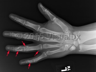 Imaging Studies image of Enchondroma - imageId=7900659. Click to open in gallery.  caption: '<span>Multiple enchondromas scattered throughout the 4th and 5th fingers.</span>'