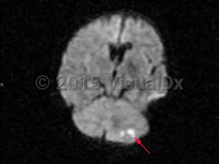 Imaging Studies image of Cerebellar stroke