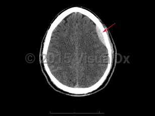 Imaging Studies image of Epidural intracranial hematoma