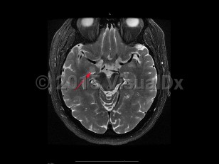 Imaging Studies image of Encephalitis - imageId=7904332. Click to open in gallery.  caption: '<span>Limbic encephalitis. Axial T2  weighted MRI of the brain demonstrates increased signal in the  right mesial temporal lobe, in this patient with small cell lung  carcinoma. Findings were consistent with a clinical diagnosis of limbic  encephalitis.</span>'