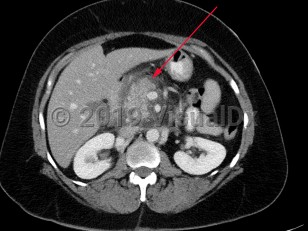 Imaging Studies image of Acute pancreatitis