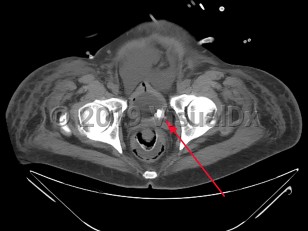 Imaging Studies image of Urinary bladder calculus - imageId=7906147. Click to open in gallery.  caption: '<span>CT scan of the pelvis, showing bladder calculi.</span>'